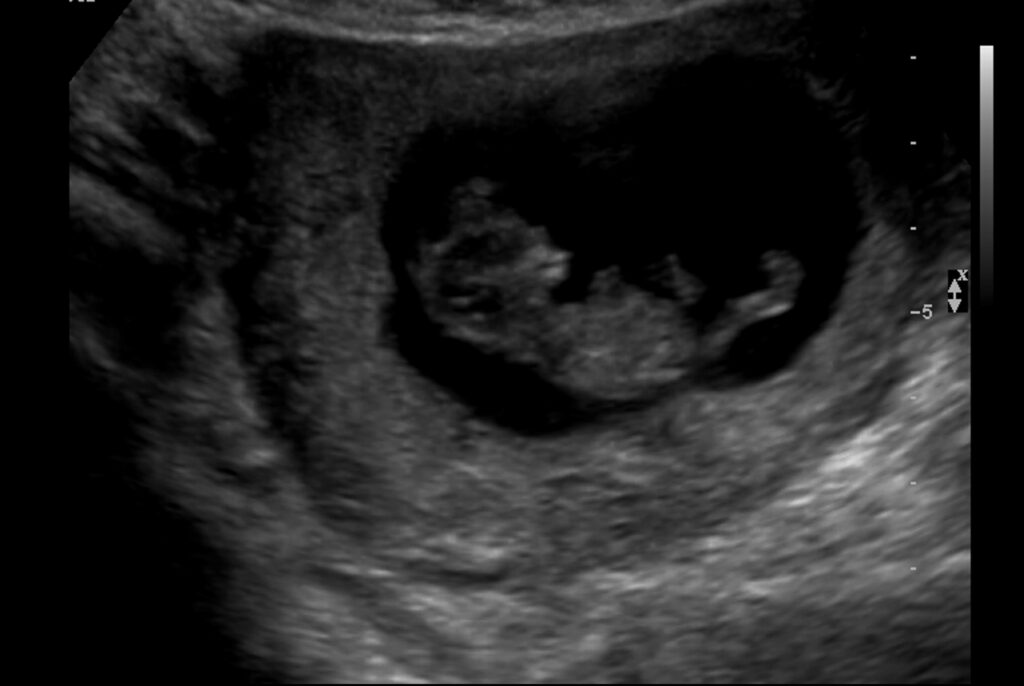 Why Ultrasound Matters