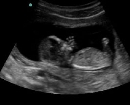 1st Trimester Ultrasound - Blended