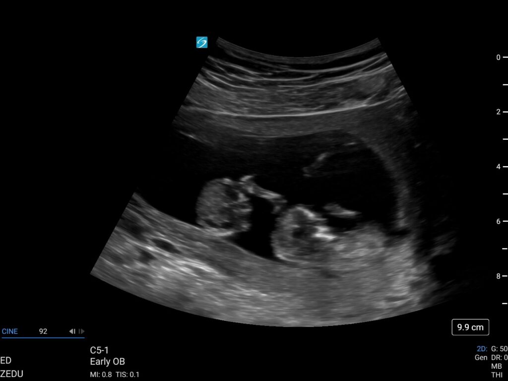 maternal fetal