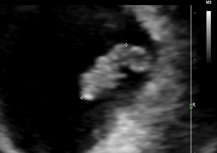 maternal fetal medicine specialist several randomised controlled trials investigating