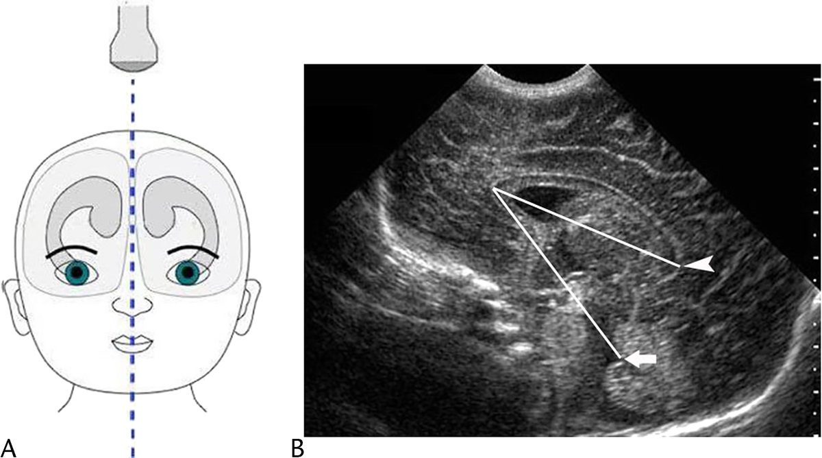 An Exploratory Study Into a New Head Ultrasound Marker for Predicting Neurodevelopmental Outcomes in Preterm Infants An Exploratory Study Into a New Head Ultrasound Marker for Predicting Neurodevelopmental Outcomes in Preterm Infants