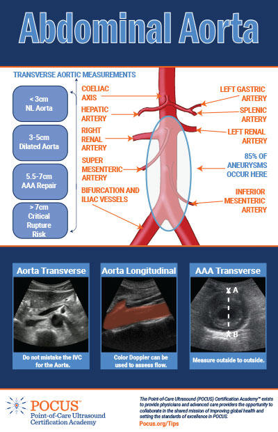 AAA measurement POCUS