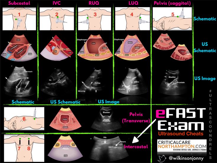 eFAST for POCUS educators