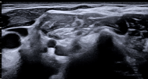 Ultrasound-Guided Regional Anaesthesia