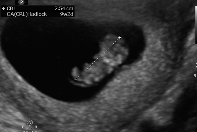 zedu emergency ultrasound point of care ultrasound emergency medicine obstetric ultrasound bedside ultrasound scanning