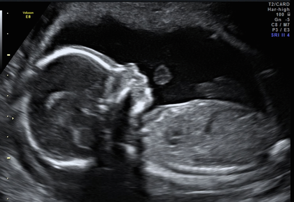 Zedu 2nd trimester ultrasound fast-track for sonographers intrauterine pregnancy