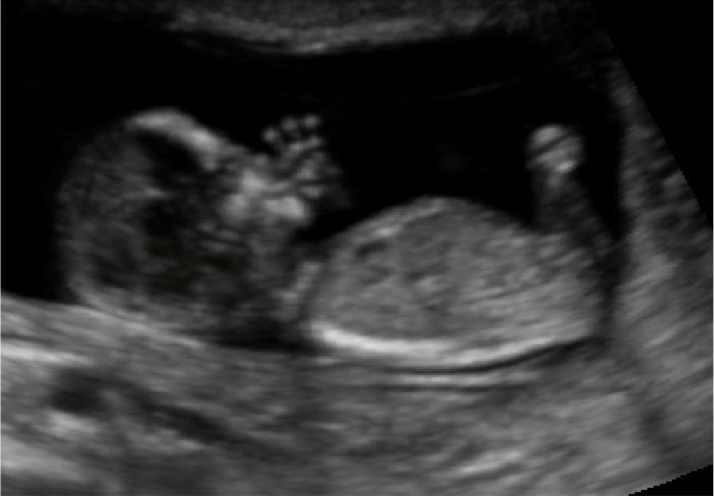 zedu obstetric ultrasound examination