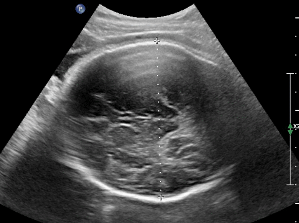 Zedu 3rd trimester obstetric ultrasound examination training fast track course for sonographers