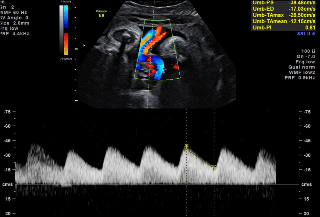 zedu umbilical artery Doppler middle cerebral artery doppler